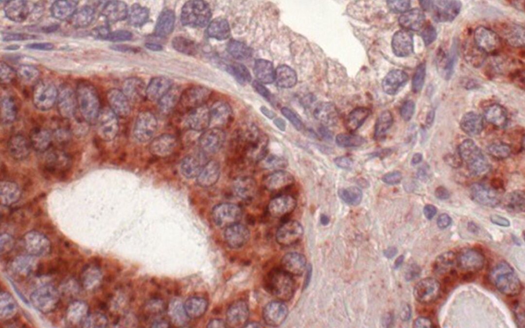 “Rogue” Protein Could Contribute to Humans’ High Cancer Rates