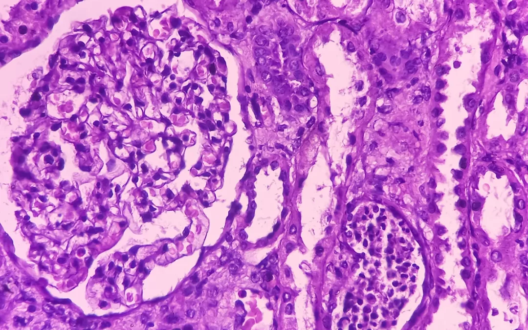 Mutational Signature Indicates Risk of Kidney Cancer Recurrence