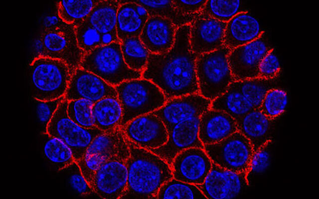 An exosome-based liquid biopsy shows promise for early detection of pancreatic cancer