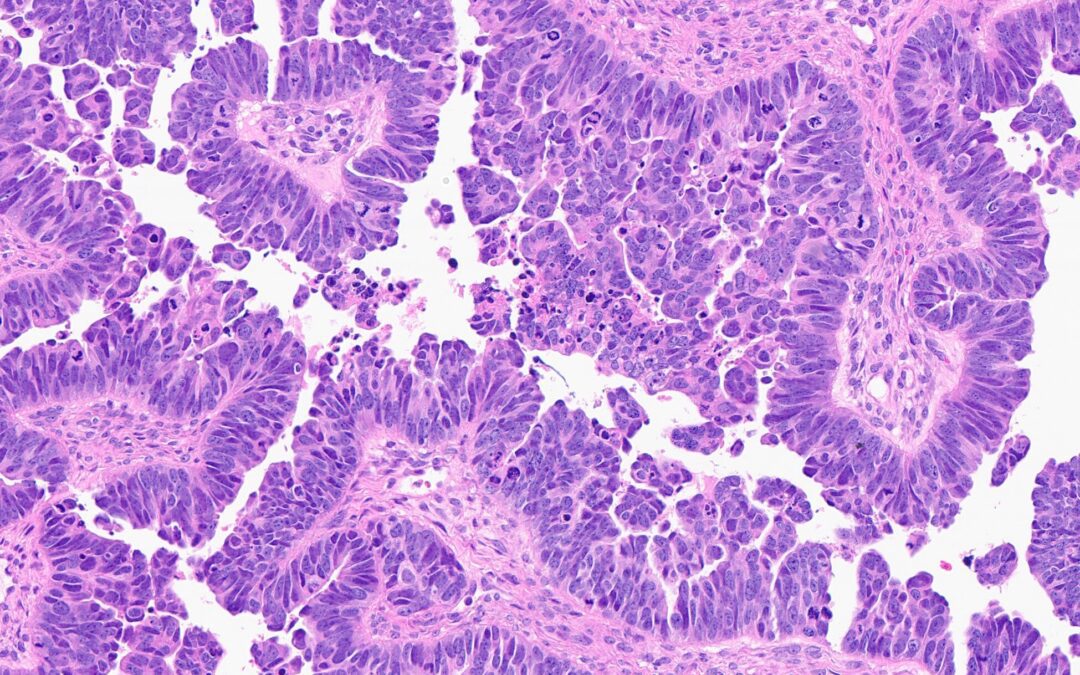 CDK12 gene inactivation: Study defines key driver of aggressive ovarian cancer