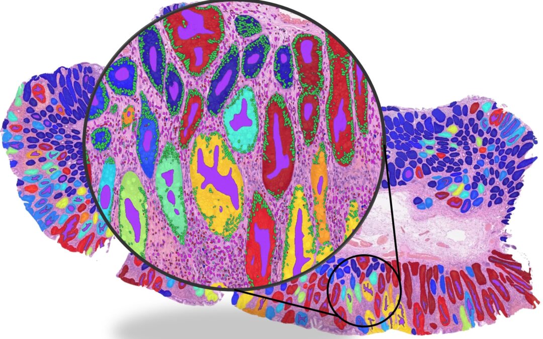 AI cancer tools may rely on ‘shortcut learning’ rather than genuine biological signals