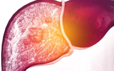 Multiomics Reveals How Macrophages Contribute to Liver Disease